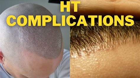 Hair Transplant Complications What Are They And How To Avoid Them Hair Restoration Questions