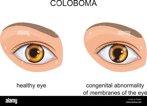 vector illustration of congenital disorder of membranes of the eye ...