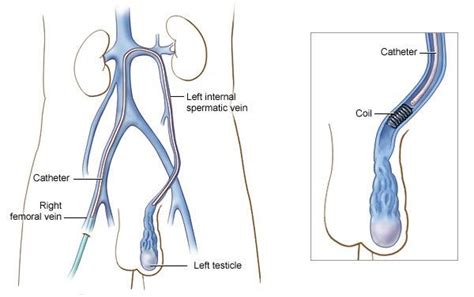 Laparoscopic Varicocelectomy A Approach To Treating Varicoceles By