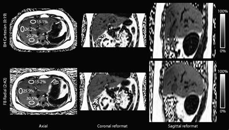 Proton Density Fat Fraction Pdff Maps For Breath Holding Cartesian