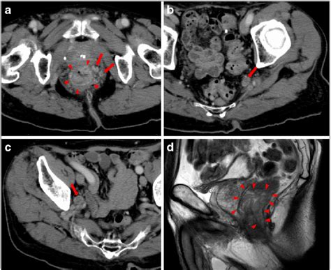 Preoperative CT And MRI Scan Of The Pelvis The Primary Tumor Area Is