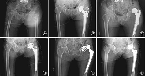 Use Of A Constrained Acetabular Liner To Prevent And Treat Recurrent