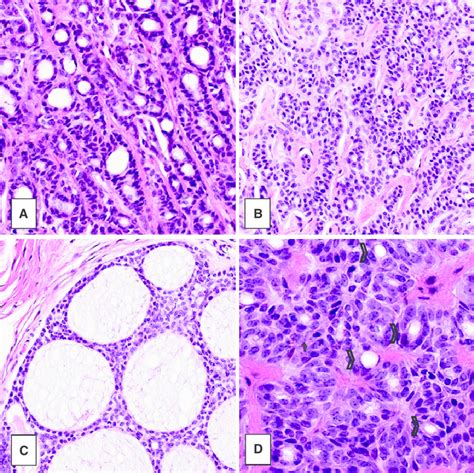 Polymorphous Sweat Gland Carcinoma Psgc Case Tubular A