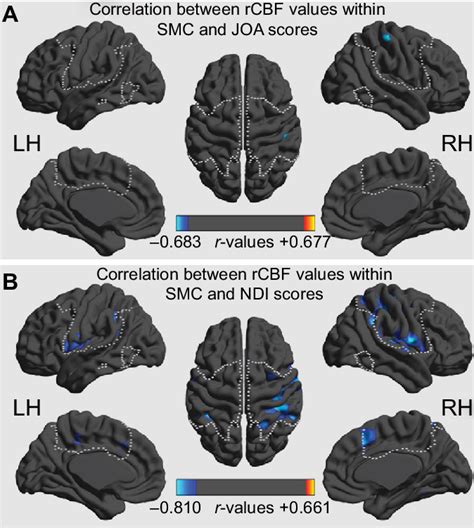 Correlations Of Rcbf Values With Joa Scores A And Ndi Scores B In