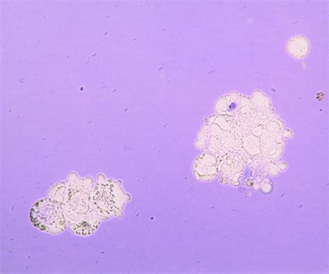 Arsenic Trioxide As2o3 Sensitivity Of Carcinoma Cell Lines And Cancer