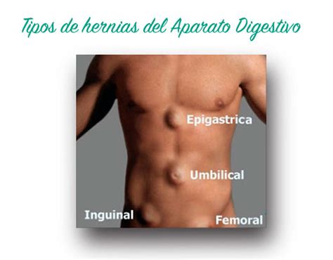 Tipos De Hernias Abdominales Images And Photos Finder The Best Porn