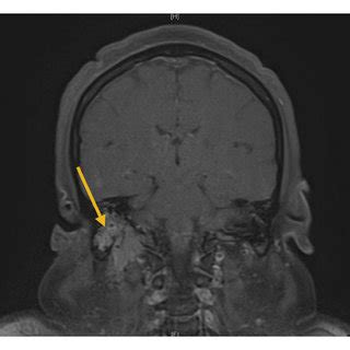 Ct Scan Of The Neck And Soft Tissue Showing And Infiltrative Mass On