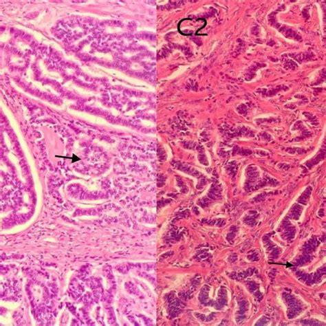 Mature Cystic Teratoma Stratified Squamous Epithelium With Skin