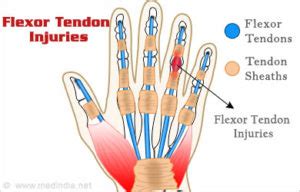 Flexor Tendon Injuries | Hand2Shoulder Clinic