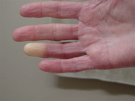 CREST Syndrome: Symptoms, Treatment, and More