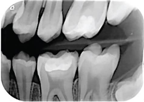 A C Follow Up Radiographs At 6 Months D H Intra Oral Views At