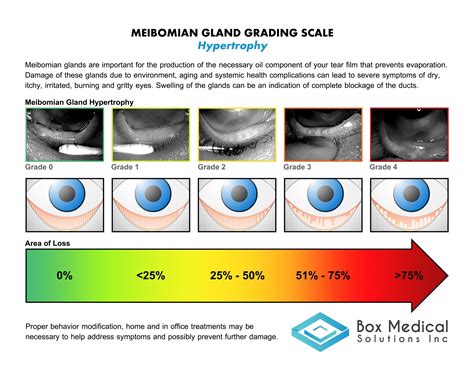 Meibomian Gland Grading Tool - Labtician Ophthalmics