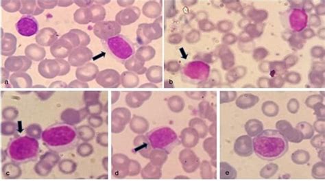 Peripheral Blood Film Shows Different Morphological Forms Of Reactive