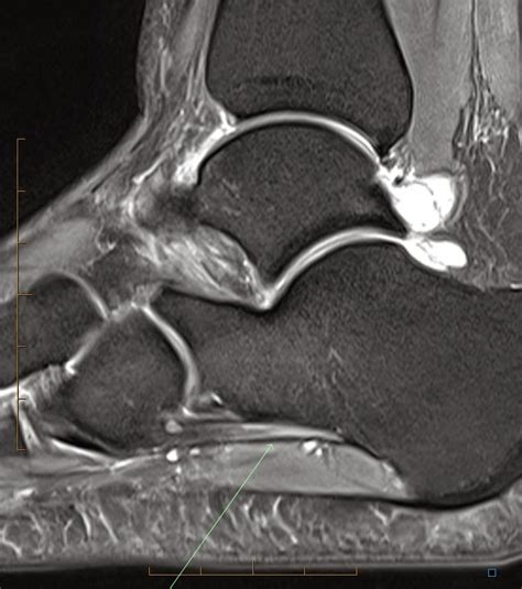 Radiology Cases Long Plantar Ligament Sprain