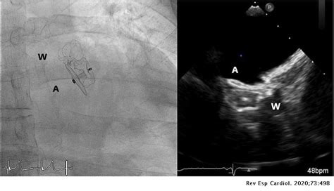 Left Atrial Appendage Closure With 2 Different Devices Revista