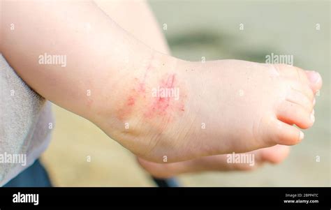 Dermatitis feet hi-res stock photography and images - Alamy