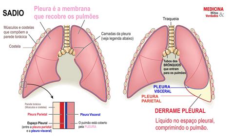 Causas E Sintomas Do Derrame Pleural Medicina Mitos E Verdades