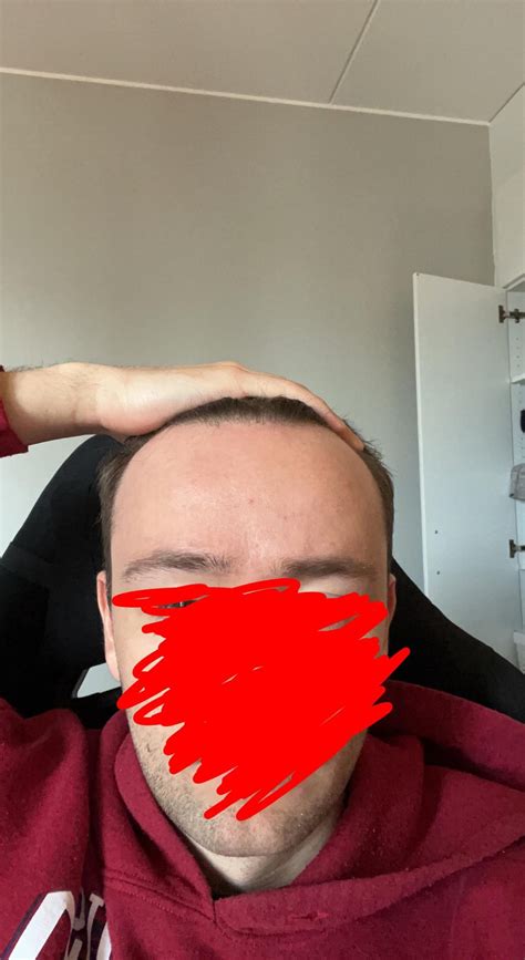 Do You Guys Think I Have A Too Big Forehead For A Buzz Cut Rmalehairadvice