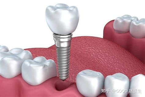 缺牙想修复，是选择活动牙还是种植牙？ 知乎