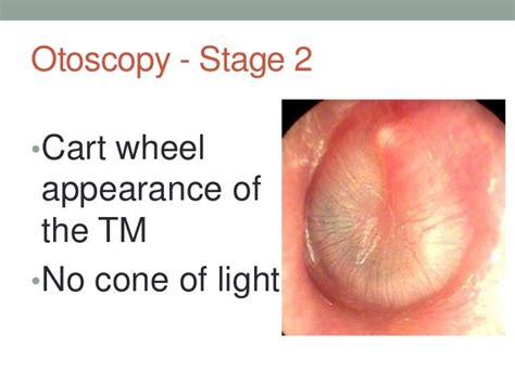 Acute Otitis Media