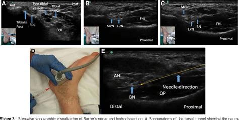 Figure 1 From Ultrasound Guided Hydrodissection For Baxter S Neuropathy Secondary To Plantar