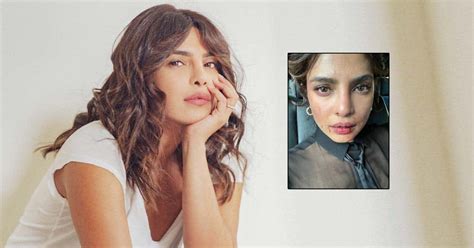 Citadel Priyanka Chopra Shares Bts Picture Of Bruised Face From The Sets