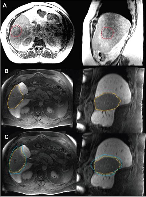 Evaluating Dose Constraints For Radiation Induced Liver Damage