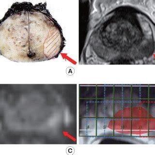 Detection Rates Of Prostate Cancer Of T1 Weighted T2 Weighted And