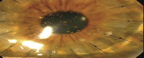 Candida Interface Keratitis After Deep Anterior Lamellar Ker Cornea