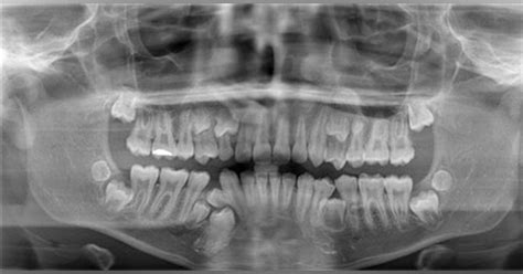 Supernumerary Teeth | Registered Dental Hygienists