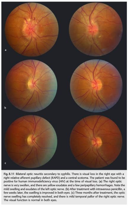 Neuro Ophthalmology Illustrated Chapter 8 Optic Neuropathies 4