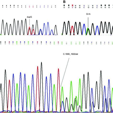 Dna Sequence Chromatograms Demonstrating Mutations At Asxl Gene