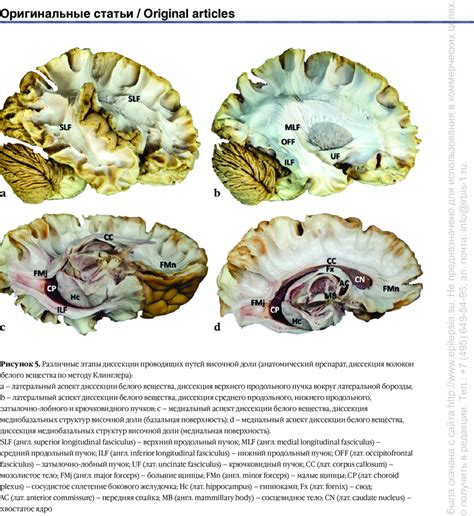 Different Stages Of Temporal Lobe Pathway Dissection Anatomical