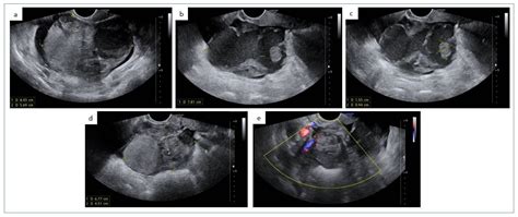 Diagnostics Free Full Text Pilomatrix Like High Grade Endometrioid