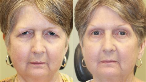 Blepharoplasty With Posterior Ptosis Eye Center South