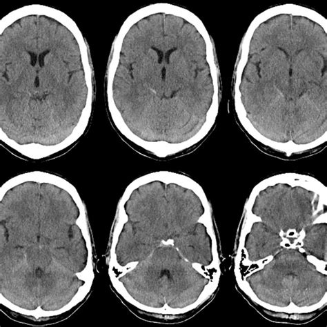 Axial Sections From Noncontrast Head Ct Demonstrating Hyperdense Download Scientific Diagram