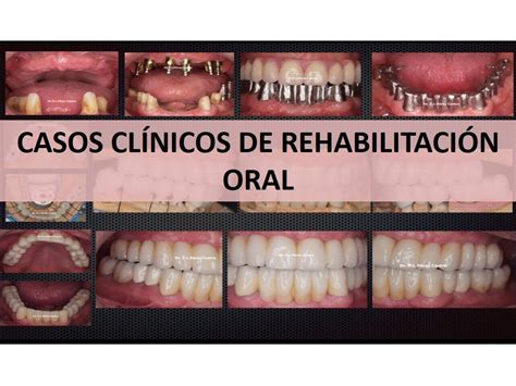 CASOS CLÍNICOS EN REHABILITACIÓN ORAL por el Dr Antonio Balarezo