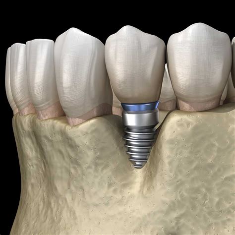 Peri Implantitis Understanding Prevention And Management