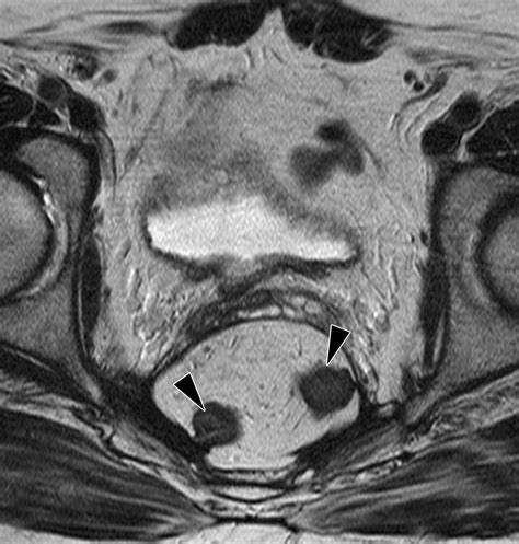 Anatomic And Pathologic Findings At External Phased Array Pelvic Mr Imaging After Surgery For