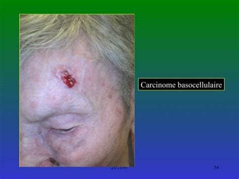 Carcinome Basocellulaire