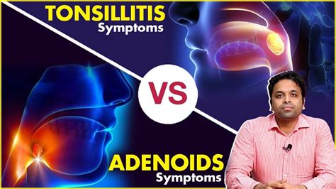 Adenotonsillitis Symptoms Tonsillitis And Adenoids Symptoms Dr