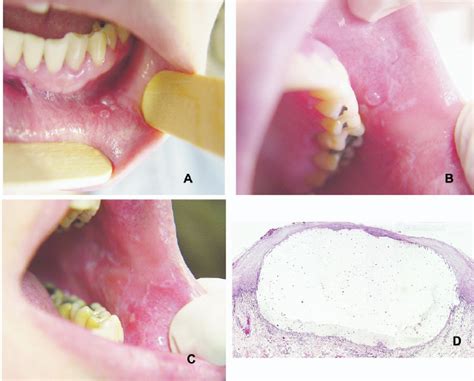 A Cluster Of Superficial Mucoceles On The Labial Mucosa B Single