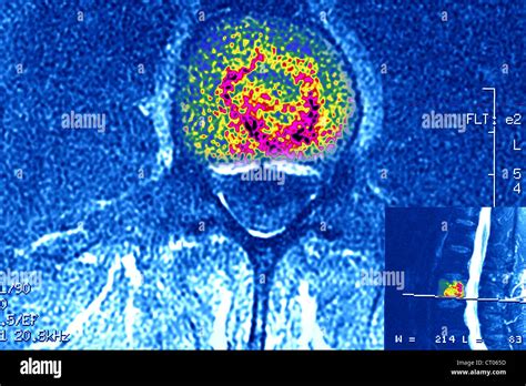 MULTIPLE MYELOMA, BONE MARROW Stock Photo - Alamy