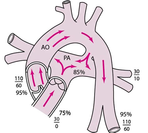 Image Patent Ductus Arteriosus Msd Manual Professional Edition