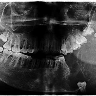 An Orthopantomograph Showing An Expansile Multilocular Radiolucent