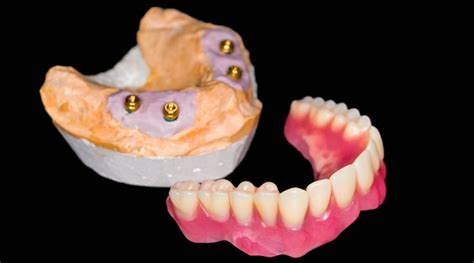 Prótesis sobre locators cuando se indican Estudi Dental Barcelona