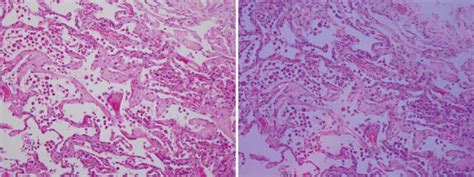 Emphysema Intechopen