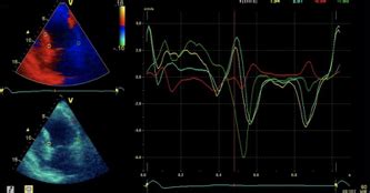 Tissue Doppler Tissue Velocity Imaging The Cardiovascular