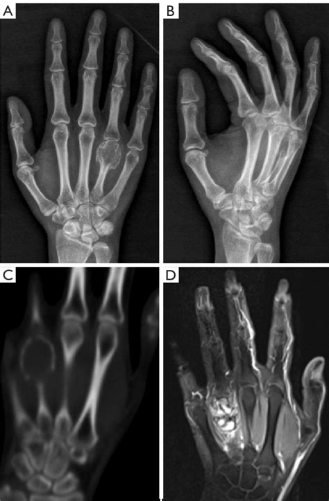 Preoperative X Ray Computed Tomography Ct And Magnetic Resonance