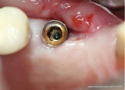 Titanium Corrosion In The Oral Environment Zeramex USA